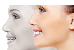 invisalign Málaga