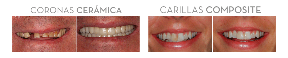 ortodoncia invisible malaga